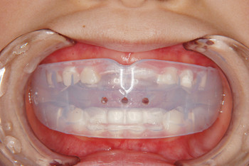 札幌市白石区南郷13丁目にあるリーサ矯正歯科 子どもの矯正 マウスピース型の装置
