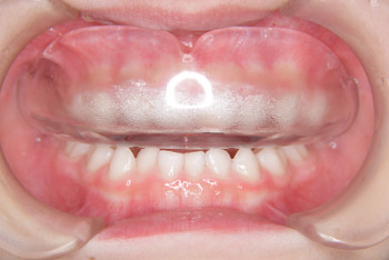 札幌市白石区南郷13丁目にあるリーサ矯正歯科 子どもの矯正 マウスピース型の装置