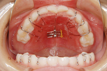 札幌市白石区南郷13丁目にあるリーサ矯正歯科 子どもの矯正 床型の矯正装置