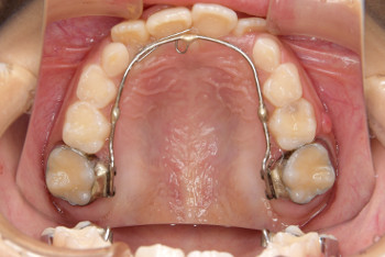 札幌市白石区南郷13丁目にあるリーサ矯正歯科 子どもの矯正