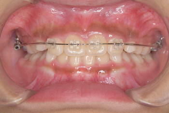 札幌市白石区南郷13丁目にあるリーサ矯正歯科 子どもの矯正