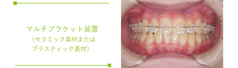 札幌市白石区南郷13丁目にあるリーサ矯正歯科 子どもの矯正