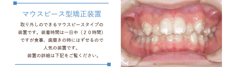 札幌市白石区南郷13丁目にあるリーサ矯正歯科 子どもの矯正
